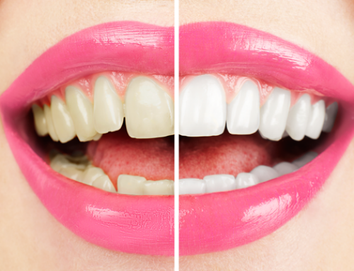 Considering tooth whitening? 9 Questions to ask…